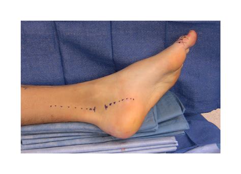 tarsal tunnel syndrome surgery pictures